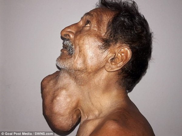 Индиец 20 лет игнорировал растущую опухоль, думая, что это щитовидная железа - «Интернет и связь»