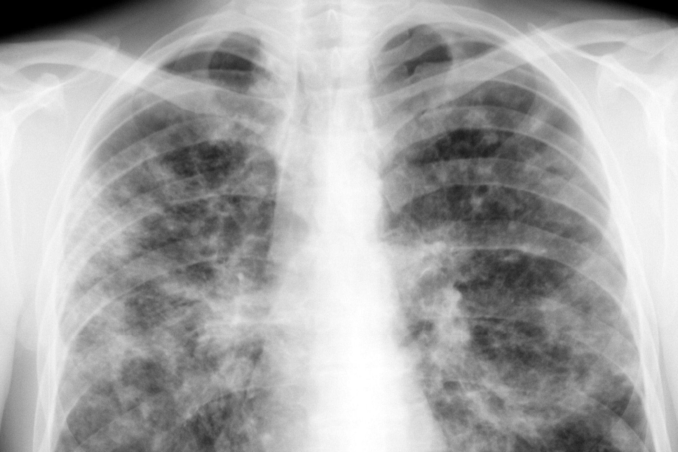 Рентгенологическая картина легочной чумы
